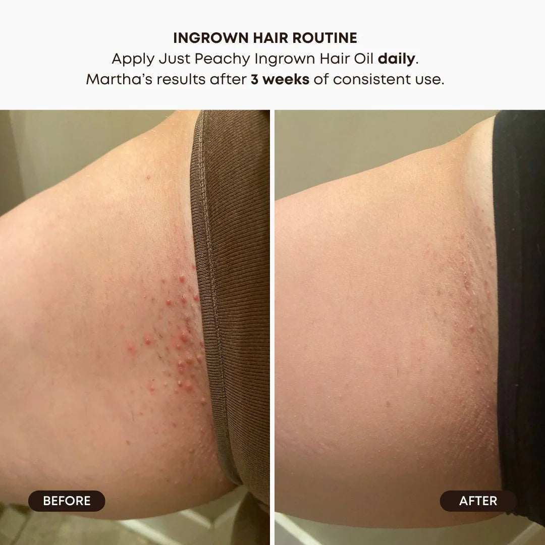 Ingrown Hair Oil - Peach*